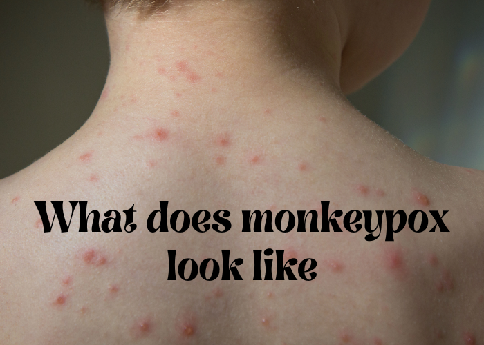 What Does Monkeypox Look Like